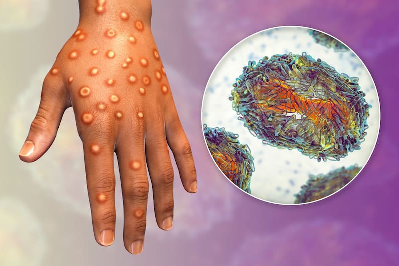 La enfermedad, también conocida como mpox o viruela símica, se transmite principalmente por contacto estrecho y prolongado con lesiones, fluidos corporales o secreciones respiratorias. (Fuente: Shutterstock)