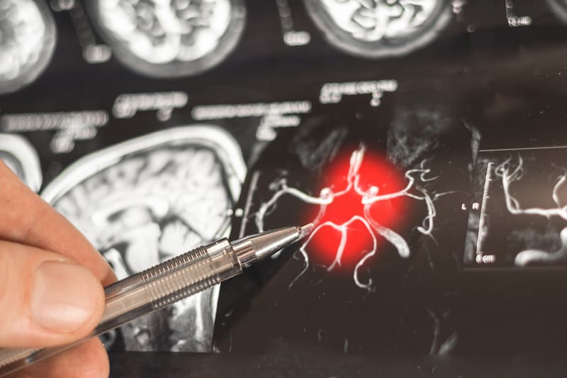 Las imágenes cerebrales permiten identificar alteraciones asociadas a la enfermedad neurodegenerativa, aunque el daño suele comenzar mucho antes.