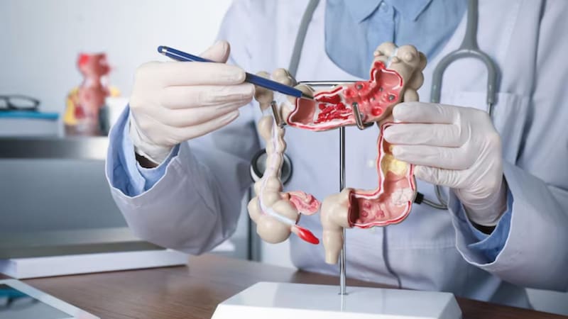 Un Premio Nobel alertó en 2017 sobre un alimento habitual en la dieta occidental y su vínculo con el cáncer de colon. Qué dijo y por qué su advertencia sigue vigente.