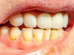 Ni bicarbonato ni vinagre: el truco para sacar el sarro de los dientes y dejarlos blancos