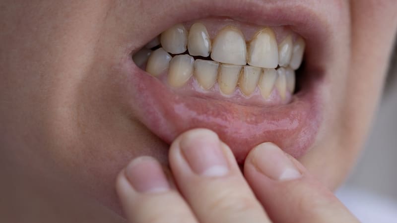Por qué es importante atender el sarro dental.
