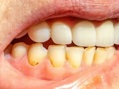 Eliminar bicarbonato o vinagre: el sistema para quitar el sarro de los dientes y conservarlos blancos