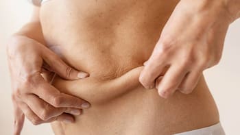 Medicamentos para adelgazar y alzhéimer: por qué la semaglutida no frena la enfermedad según un estudio clave