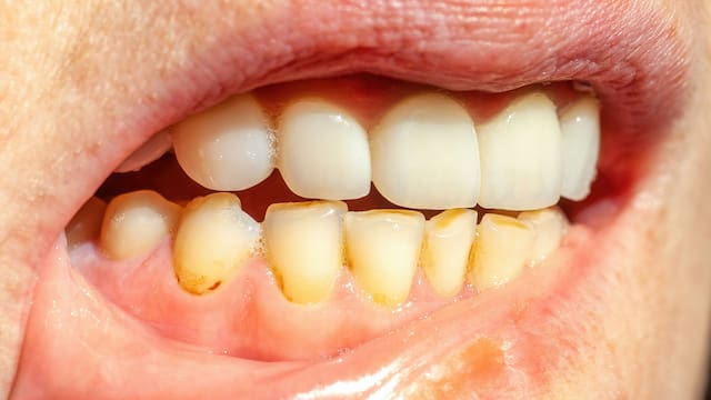 Ni vinagre ni bicarbonato: el increíble truco casero para eliminar el sarro de los dientes