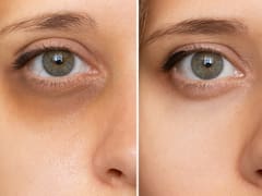 Adiós a las ojeras | El truco casero para eliminar las bolsas de los ojos: fácil, rápido y funciona