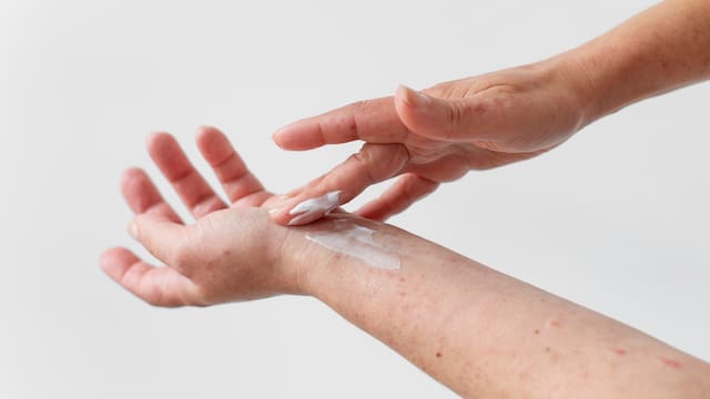 El remedio natural que todos ignoran y que acelera la curación de las quemaduras de forma efectiva