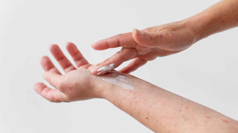 El remedio natural que todos ignoran y que acelera la curación de las quemaduras de forma efectiva.