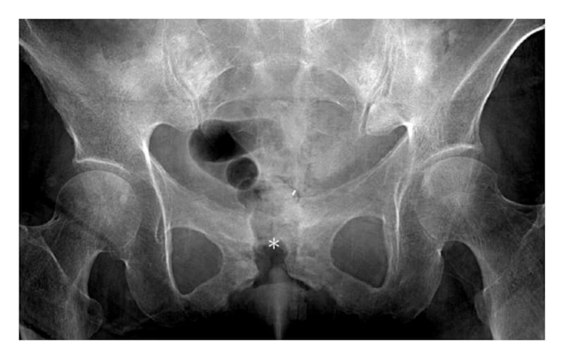 La osteomielitis púbica afecta a la sínfisis del pubis y se diagnostica mediante pruebas de imagen y estudios microbiológicos.