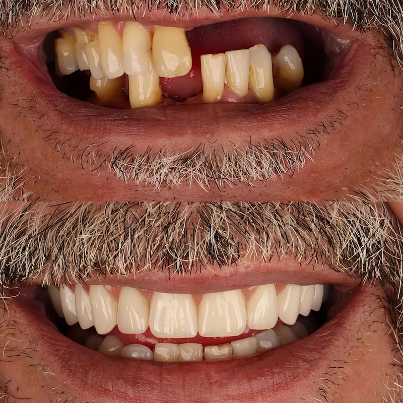 Utilizan ataches y ganchos apoyados en los dientes para lograr su retención.