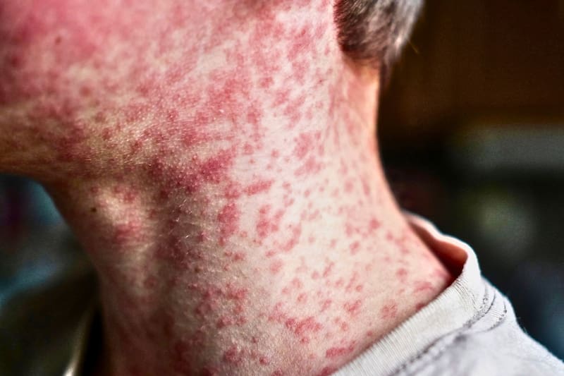 El sarampión es una enfermedad viral de alta transmisibilidad que se propaga a través de gotículas respiratorias.