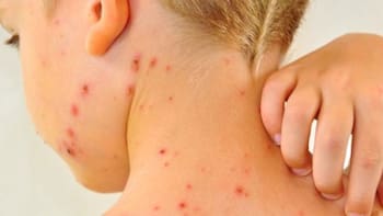 Se detectó nuevo caso de sarampión y el Ministerio de Salud Pública trabaja para controlar contagios