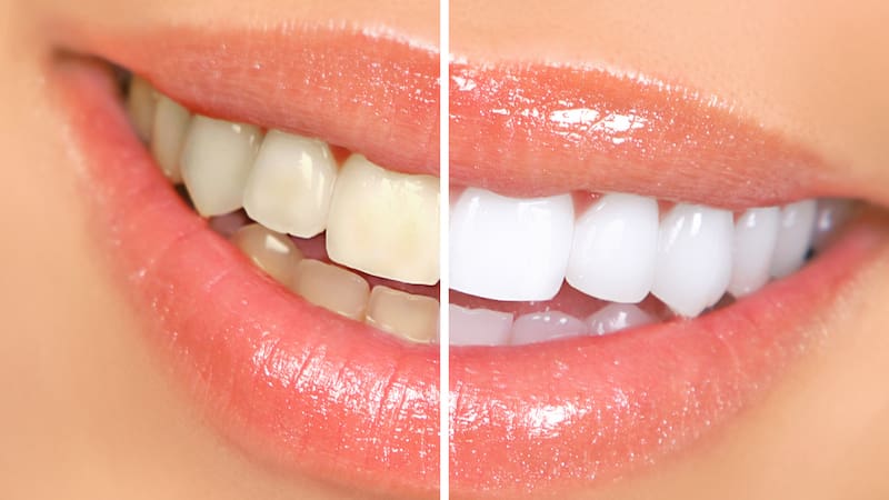 Ni bicarbonato ni limón: la forma ideal de sacar el sarro de los dientes sin pasar por el dentista