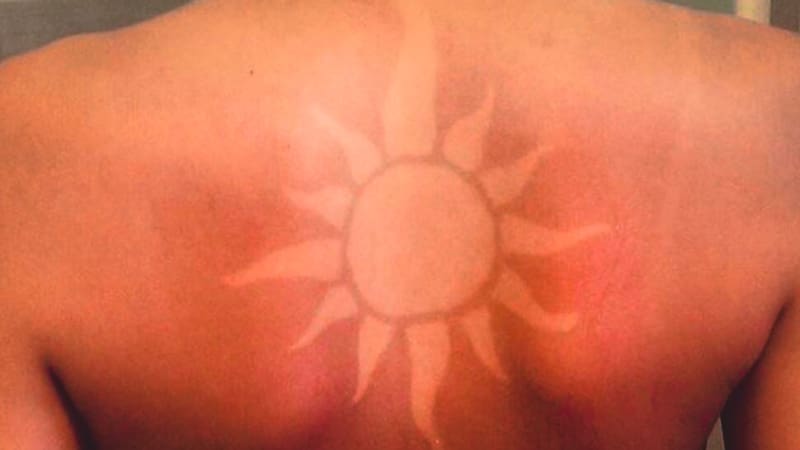 Con la llegada del verano y las altas temperaturas, las redes sociales volvieron a poner de moda una tendencia que preocupa seriamente a los especialistas: los tatuajes solares o "Sunburn Art".