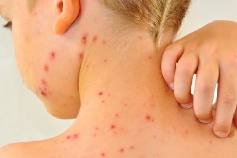 Una enfermedad muy contagiosa vuelve a encender las alertas en el país. Las autoridades sanitarias piden prestar atención a los síntomas y reforzar la prevención.