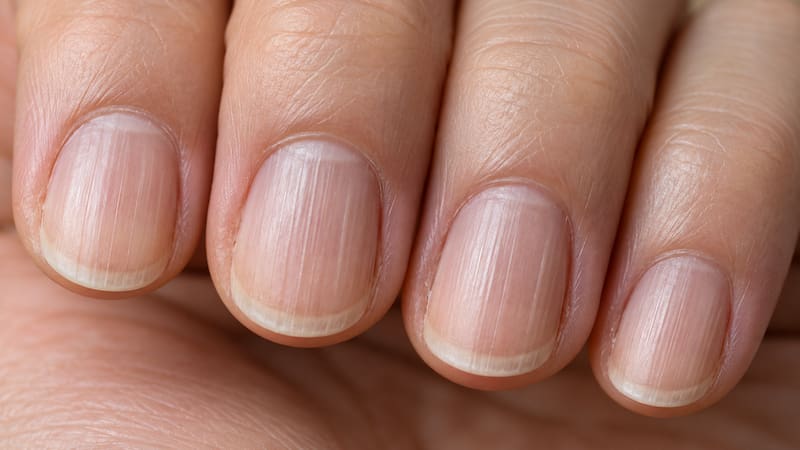 Qué significa tener rayas verticales en las uñas y cuándo es una alerta para consultar al médico.