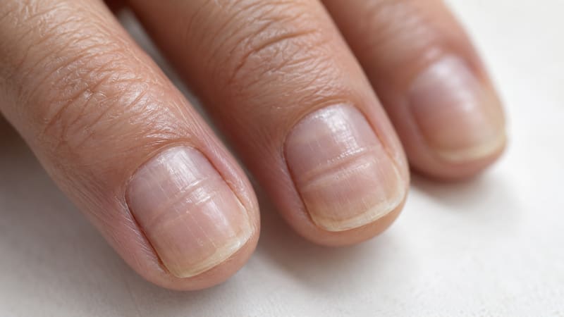Qué significa tener rayas verticales en las uñas y cuándo es una alerta para consultar al médico.