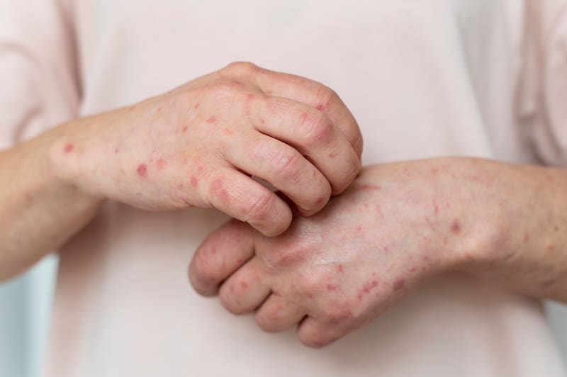 Los síntomas del herpes zóster y la neuralgia posherpética.