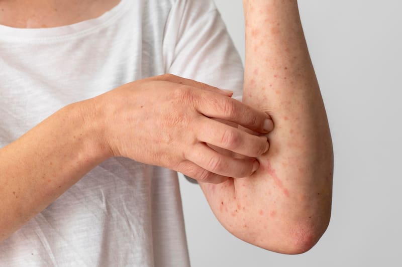 Cómo el herpes zóster puede afectar las arterias.